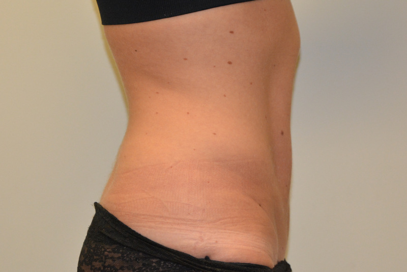 Mini-Tummy-Tuck-02 | After Mini Tummy Tuck 3