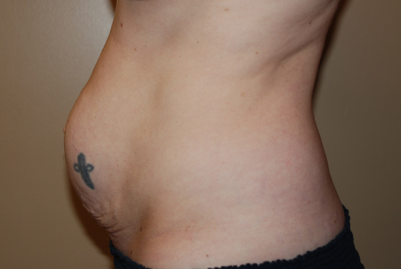 Tummy-Tuck-03 | Before Tummy Tuck 3