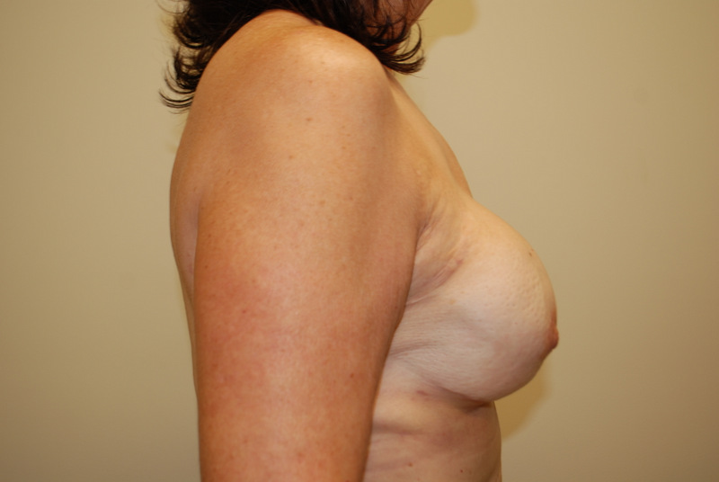 Breast-Reconstruction-Tissue-Expander-02 | After Breast Reconstruction Tissue Expanders 3