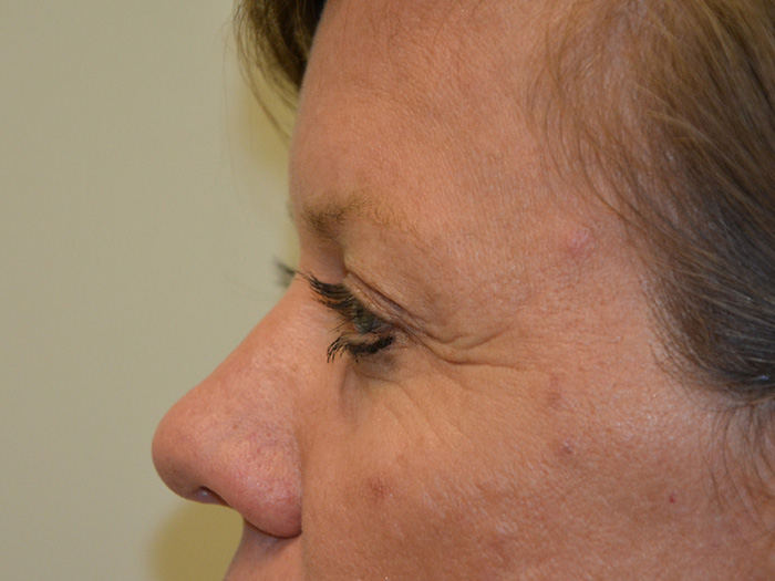 Brow-Lift-02 | After Brow Lift 4