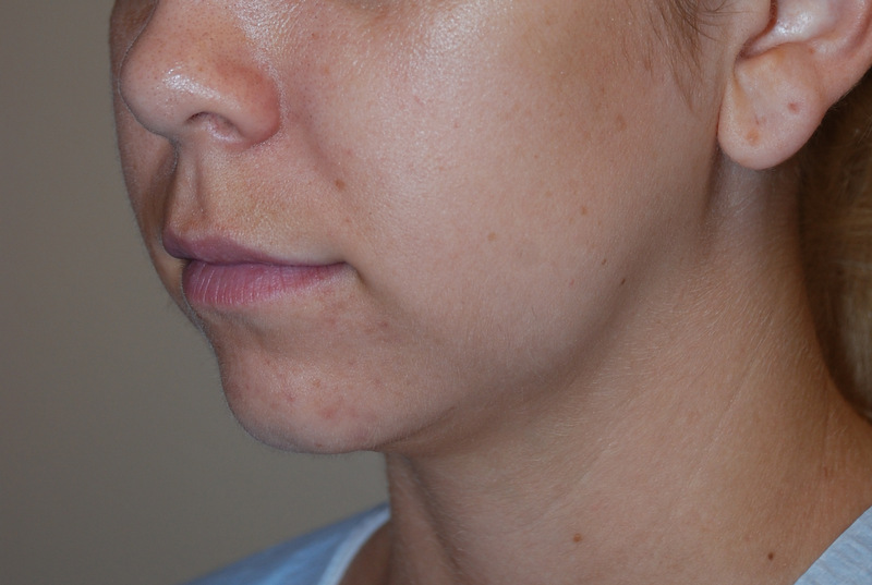 Neck-Liposuction-03 | Before Neck Liposuction 4