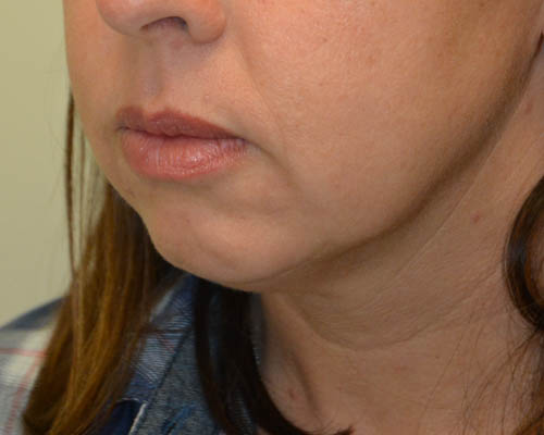 Chin-Augmentation-02 | Before Chin Augmentation 4