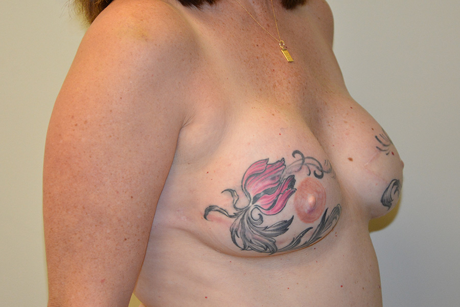 Breast-Reconstruction-TRAM-Flap-02 | After Breast Reconstruction TRAM Flap 2