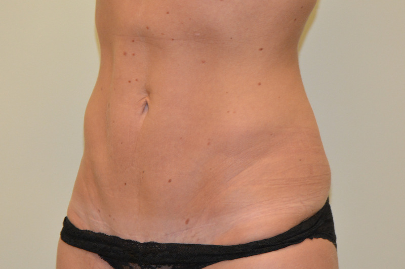 Mini-Tummy-Tuck-02 | After Mini Tummy Tuck 2