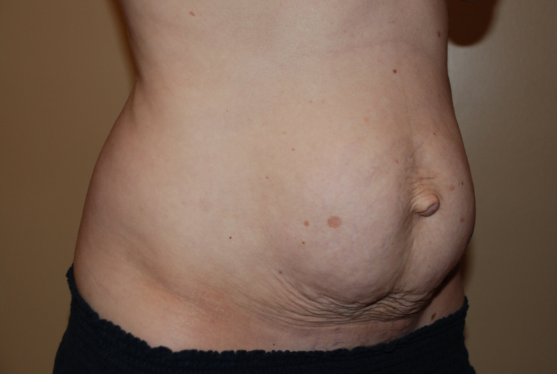 Tummy-Tuck-03 | Before Tummy Tuck 4