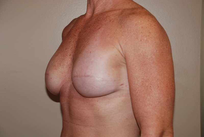 Breast-Reconstruction-Immediate-Implant-02 | After Breast Reconstruction Immediate Implant 4