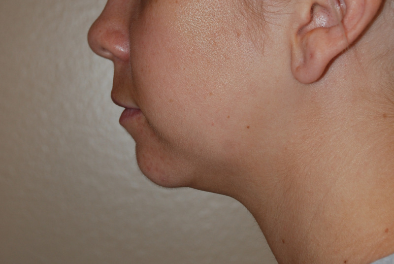 Neck-Liposuction-03 | Before Neck Liposuction 5