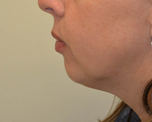 Chin-Augmentation-02 | Before Chin Augmentation 5