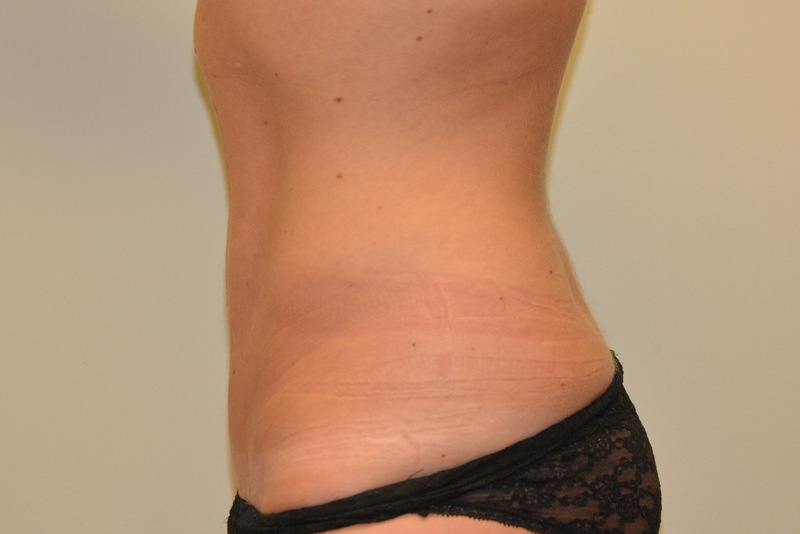 Mini-Tummy-Tuck-02 | After Mini Tummy Tuck 4