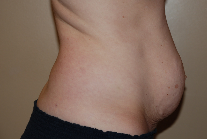 Tummy-Tuck-03 | Before Tummy Tuck 5