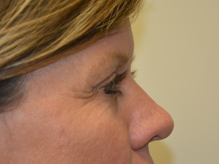 Brow-Lift-02 | After Brow Lift 5