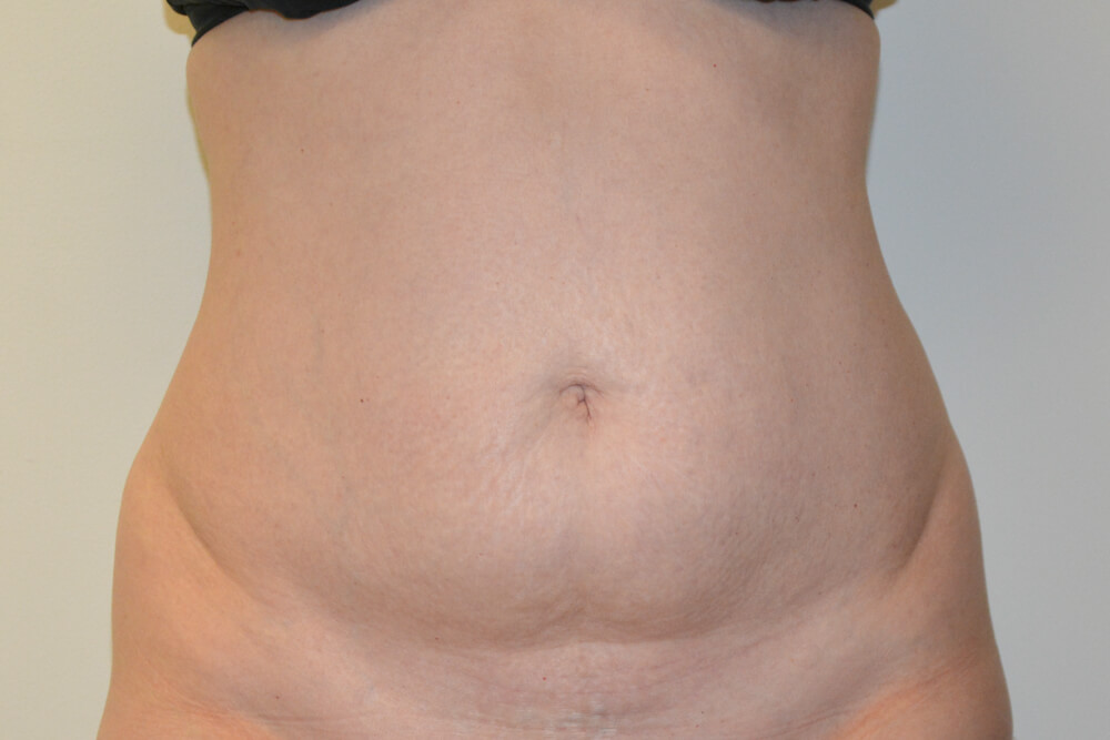 Tummy-Tuck-30 | Before Tummy Tuck