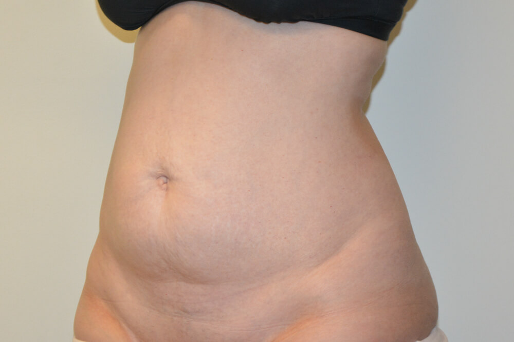 Tummy-Tuck-30 | Before Tummy Tuck 4