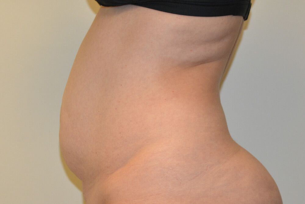 Tummy-Tuck-30 | Before Tummy Tuck 5