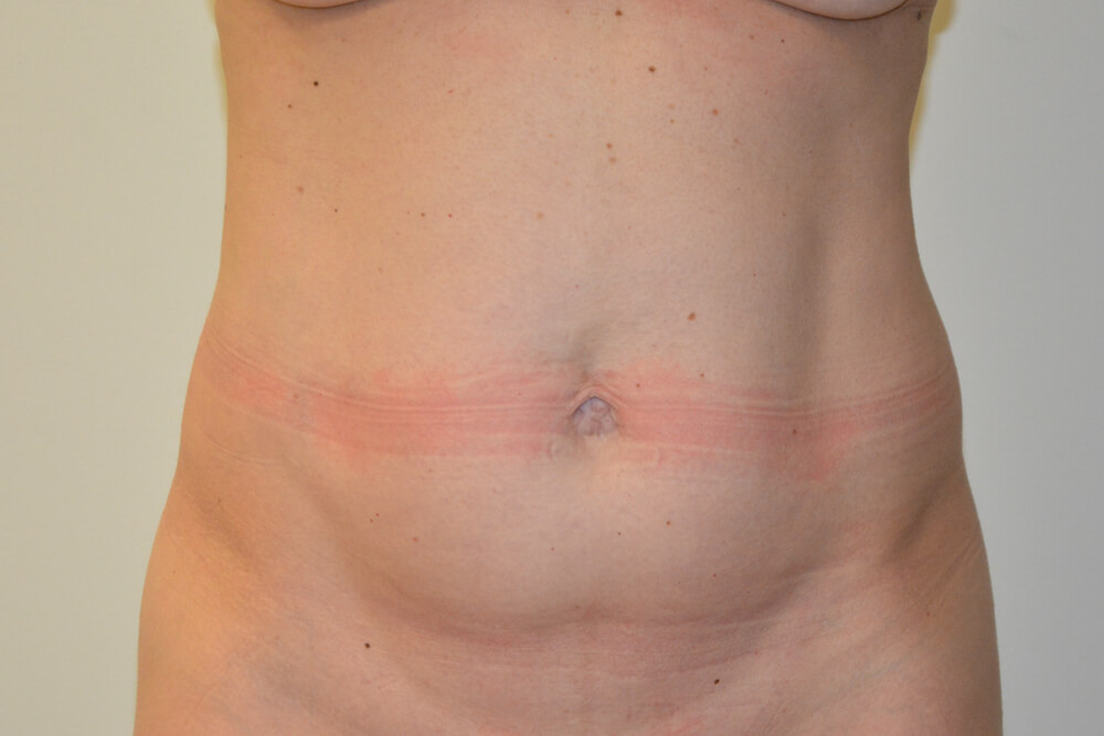 Tummy-Tuck-31 | Before Tummy Tuck