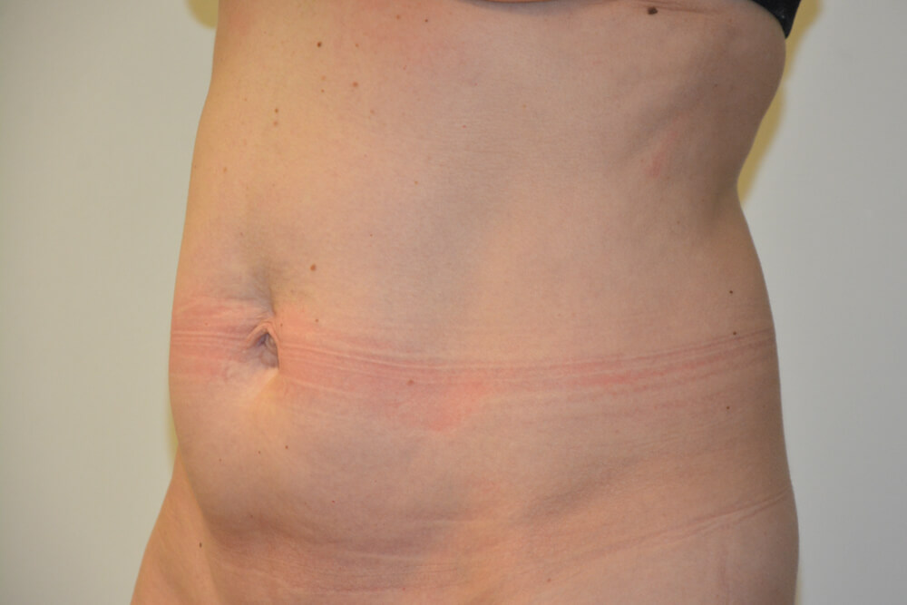 Tummy-Tuck-31 | Before Tummy Tuck 2