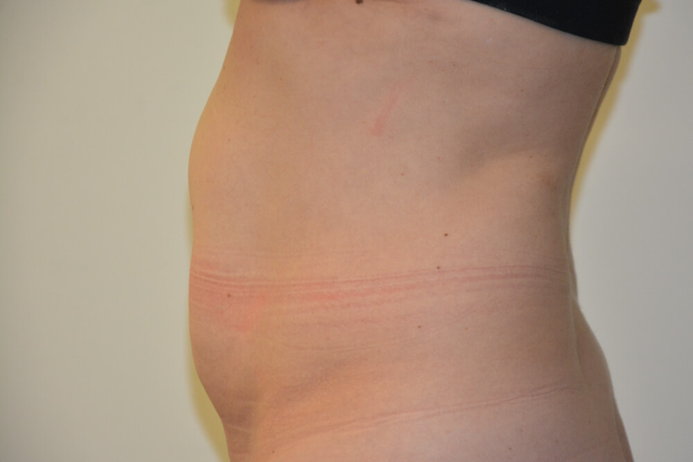 Tummy-Tuck-31 | Before Tummy Tuck 3