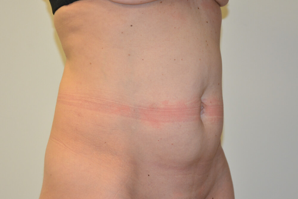 Tummy-Tuck-31 | Before Tummy Tuck 4