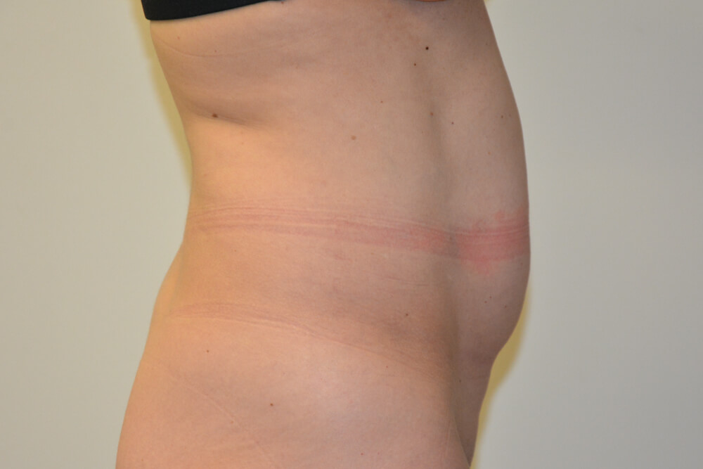 Tummy-Tuck-31 | Before Tummy Tuck 5