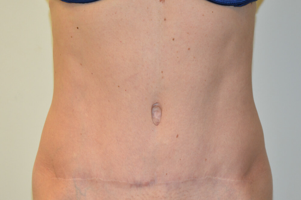 Tummy-Tuck-31 | After Tummy Tuck