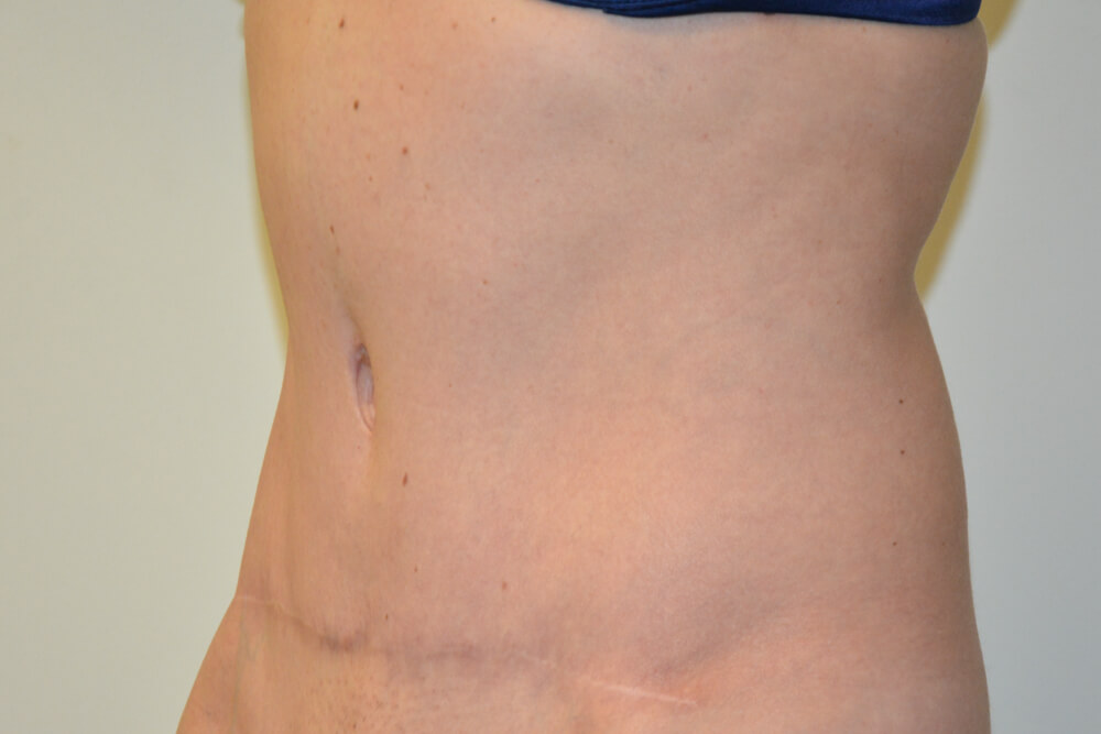 Tummy-Tuck-31 | After Tummy Tuck 2