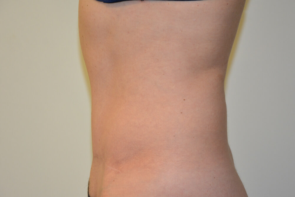 Tummy-Tuck-31 | After Tummy Tuck 3