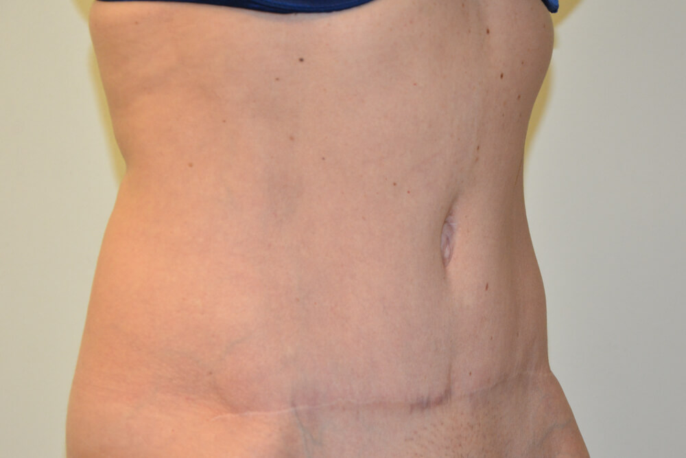 Tummy-Tuck-31 | After Tummy Tuck 4