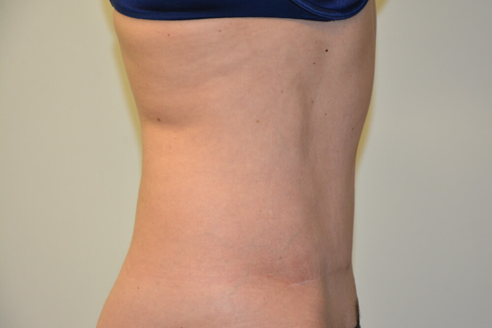 Tummy-Tuck-31 | After Tummy Tuck 5
