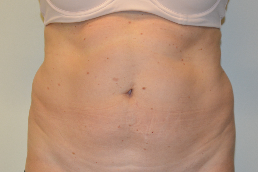 Tummy-Tuck-32 | Before Tummy Tuck