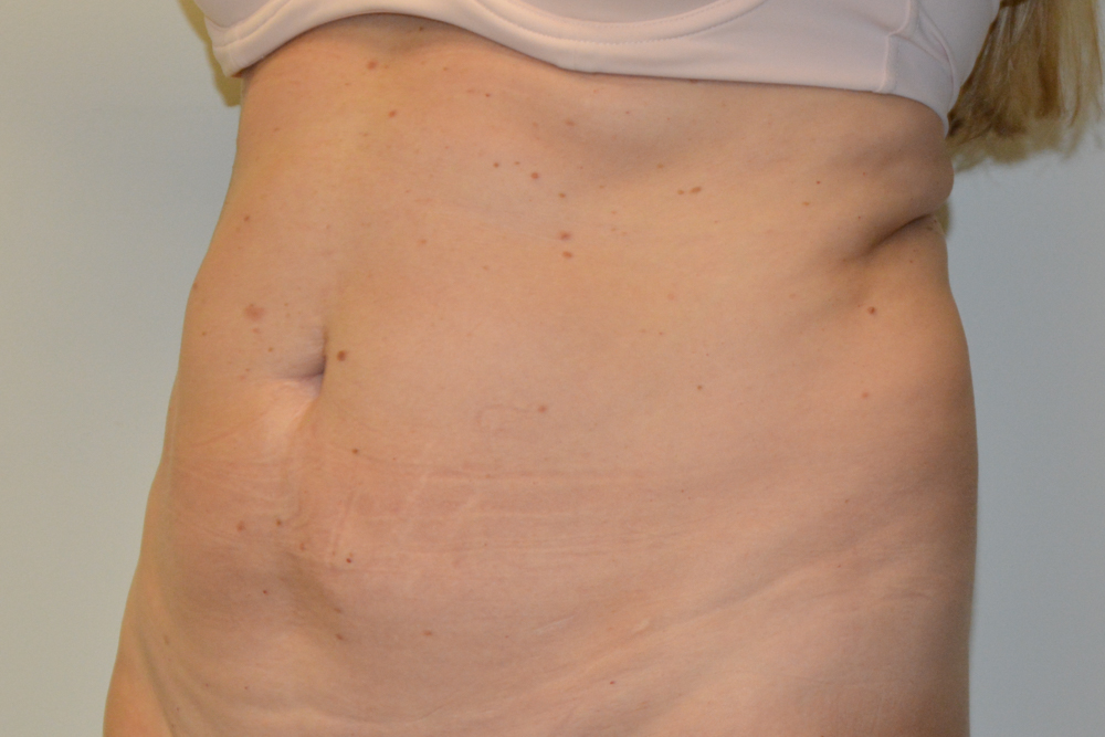 Tummy-Tuck-32 | Before Tummy Tuck 4