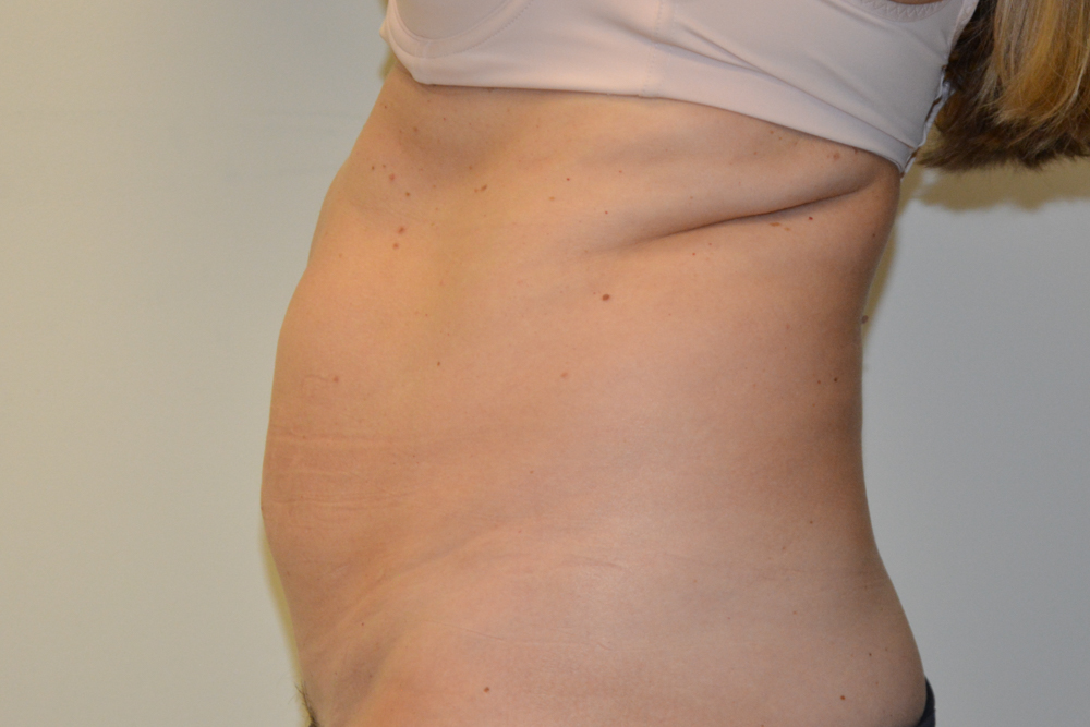 Tummy-Tuck-32 | Before Tummy Tuck 5