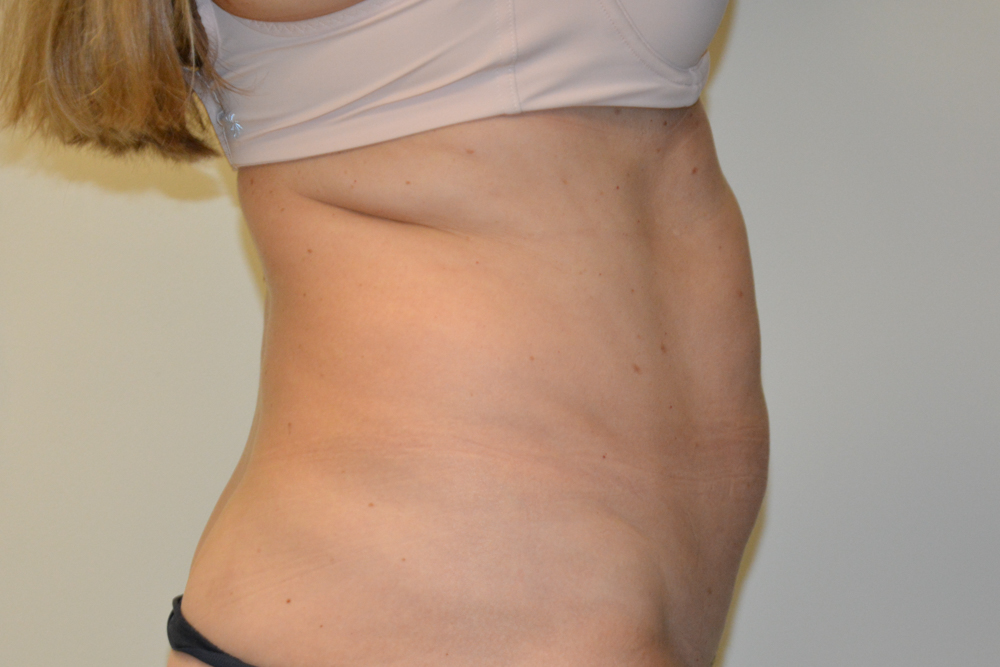 Tummy-Tuck-32 | Before Tummy Tuck 3