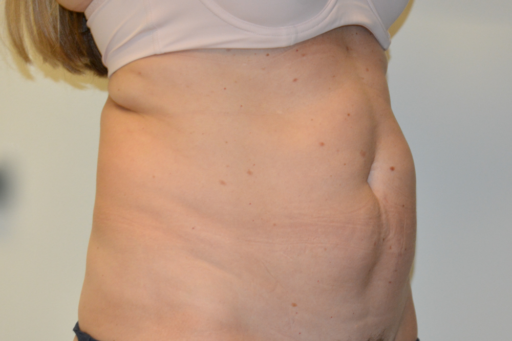 Tummy-Tuck-32 | Before Tummy Tuck 2