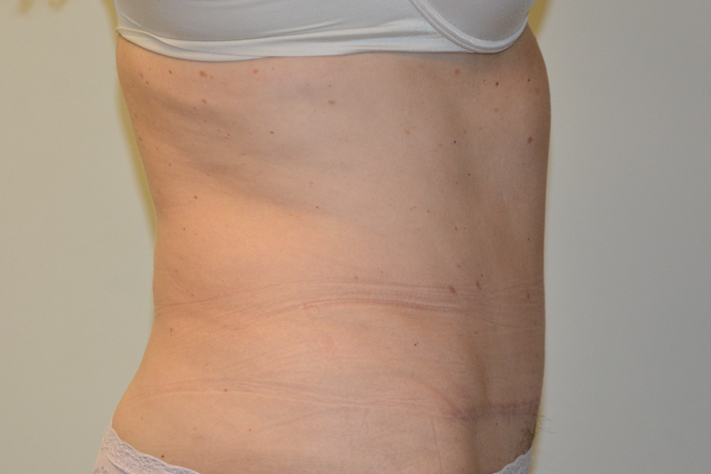 Tummy-Tuck-32 | After Tummy Tuck 3