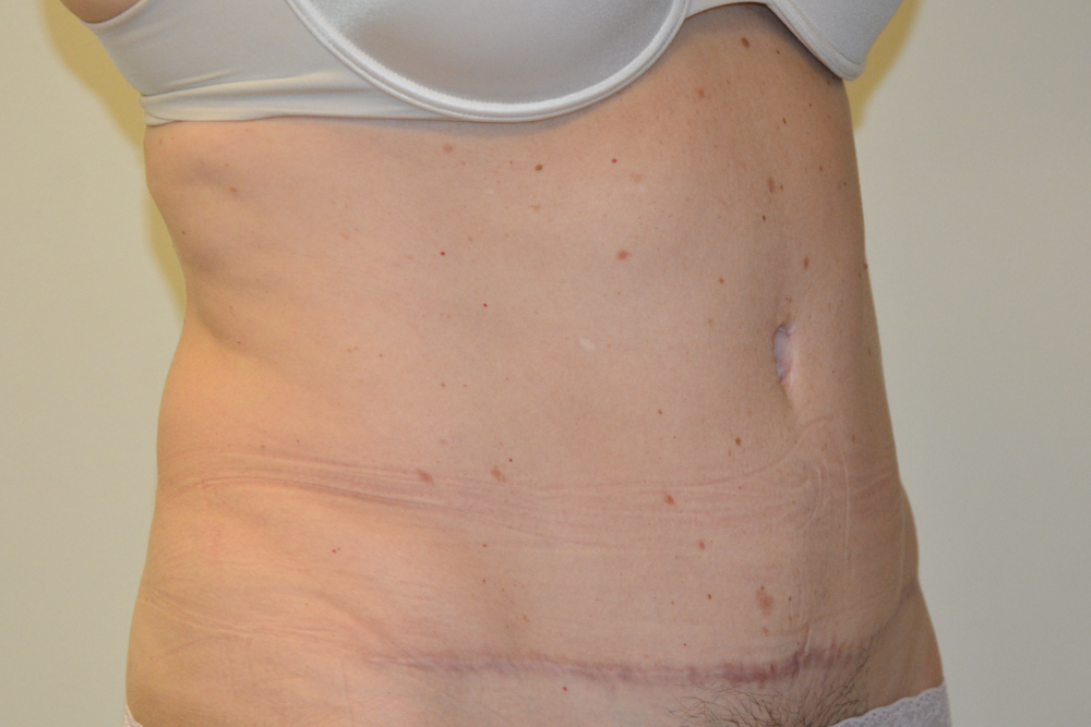 Tummy-Tuck-32 | After Tummy Tuck 2