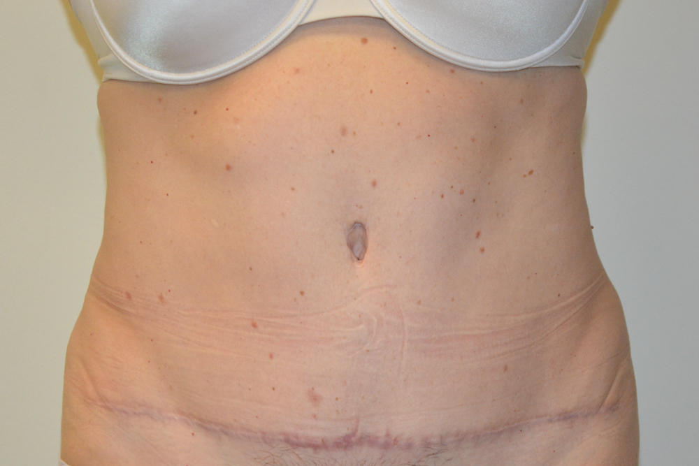 Tummy-Tuck-32 | After Tummy Tuck