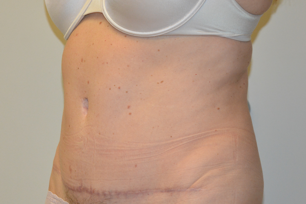 Tummy-Tuck-32 | After Tummy Tuck 4
