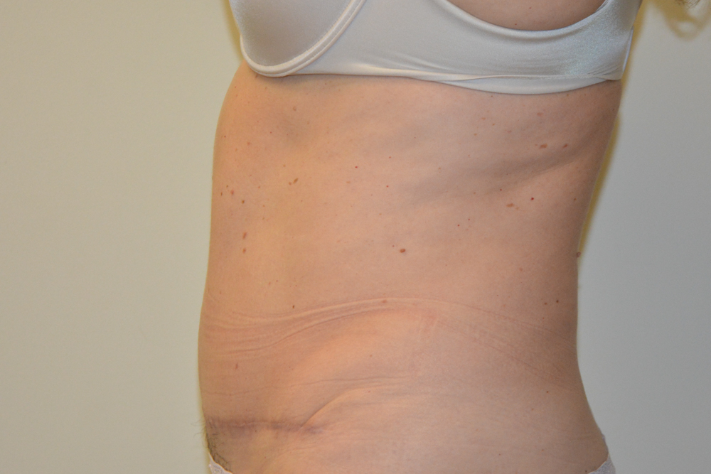 Tummy-Tuck-32 | After Tummy Tuck 5