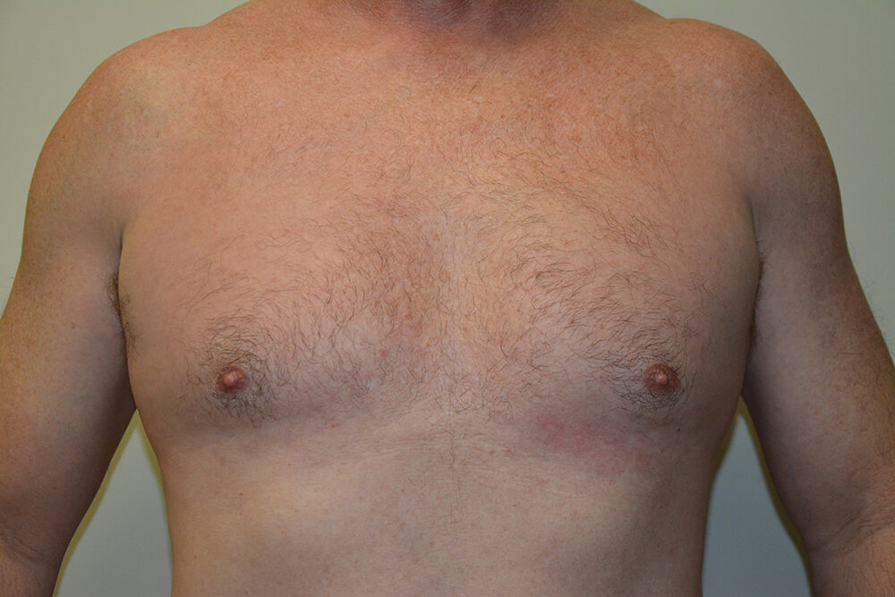 Male-Breast-Reduction-03 | Before Male Breast Reduction