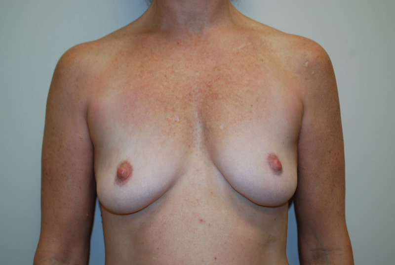 Breast-Augmentation-03 | Before Breast Augmentation