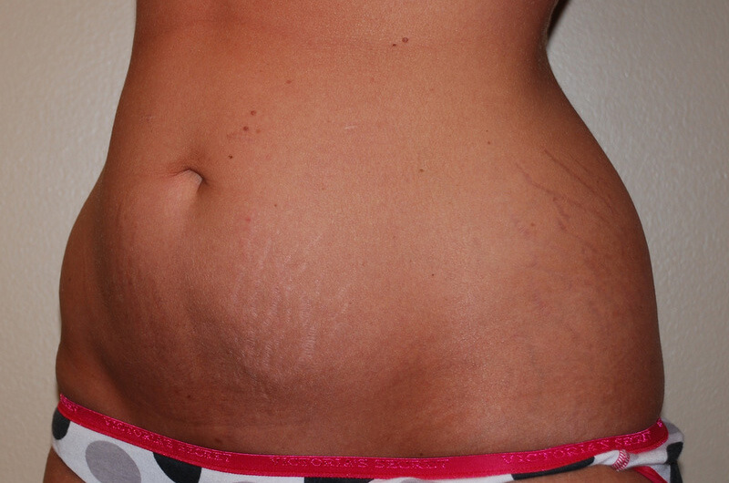 Liposuction-02 | Before Liposuction 2