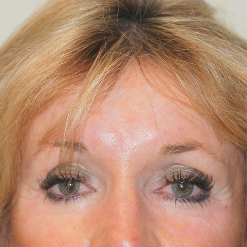 Brow-Lift-03 | Before Brow Lift