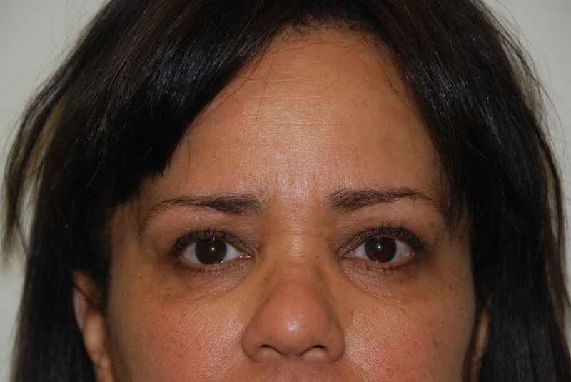 Eyelid-Surgery-05 | Before Eyelid Surgery 1