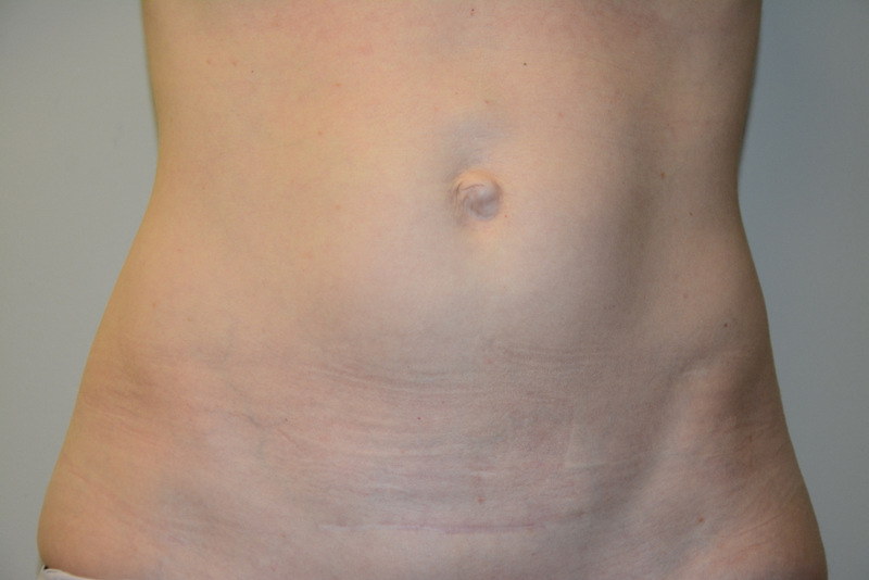 Mini-Tummy-Tuck-03 | Before Mini Tummy Tuck 1