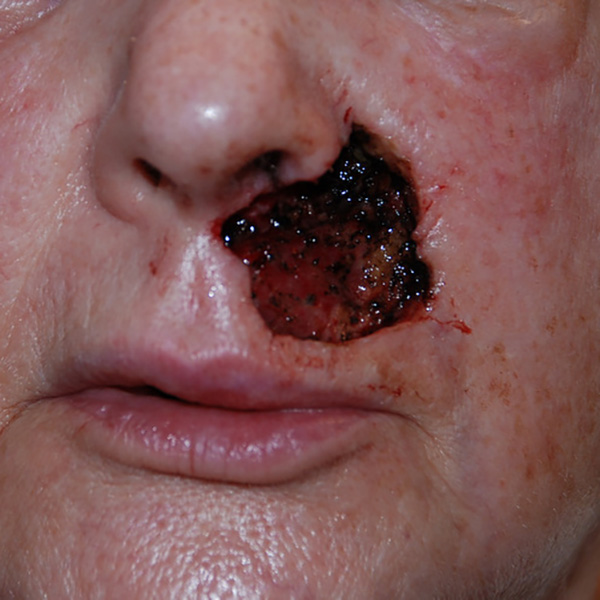 Skin-Cancer-Reconstruction-03 | Before Skin Cancer Reconstruction