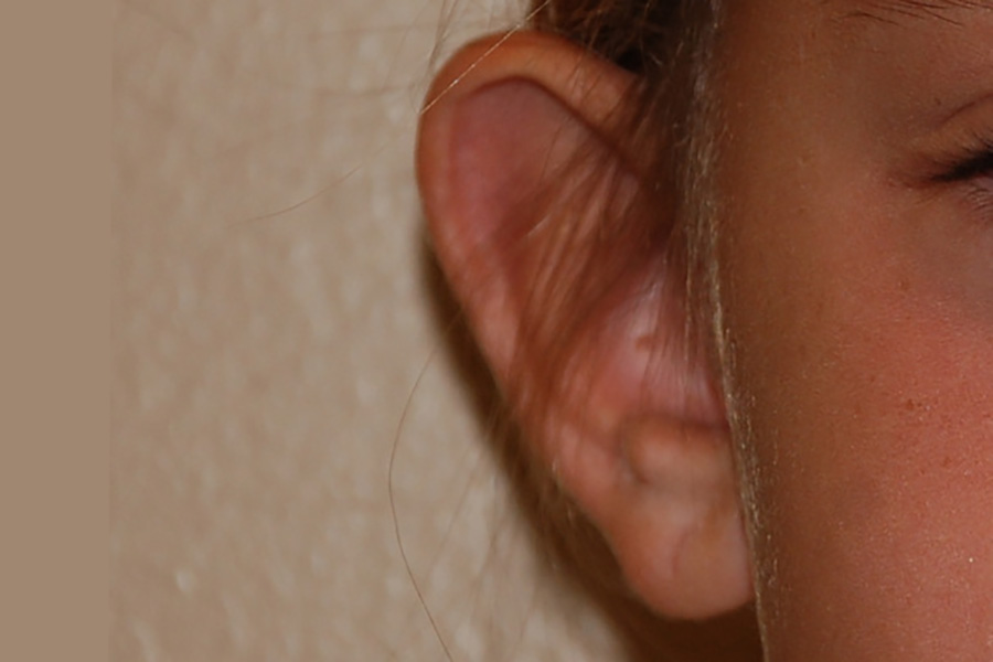 Prominent-Ear-Surgery-03 | Before Prominent Ear Surgery