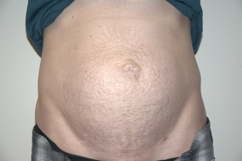Tummy-Tuck-04 | Before Tummy Tuck
