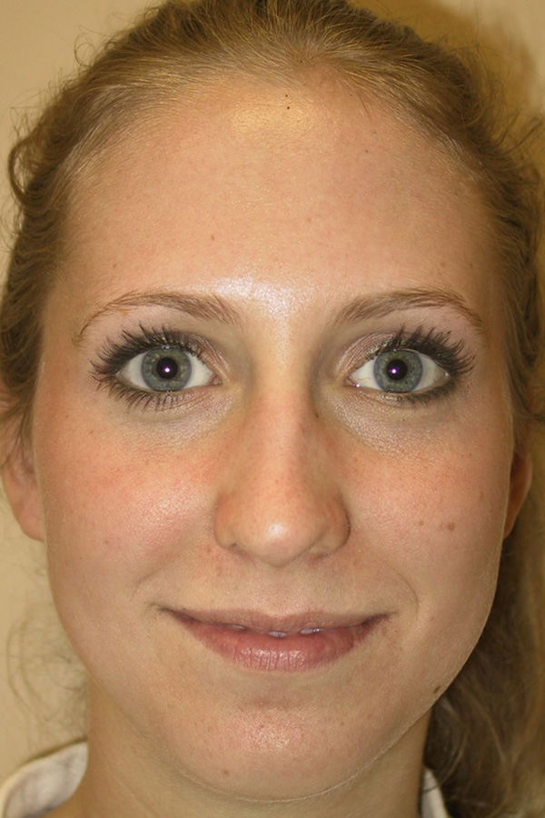 Rhinoplasty-03 | Before Rhinoplasty