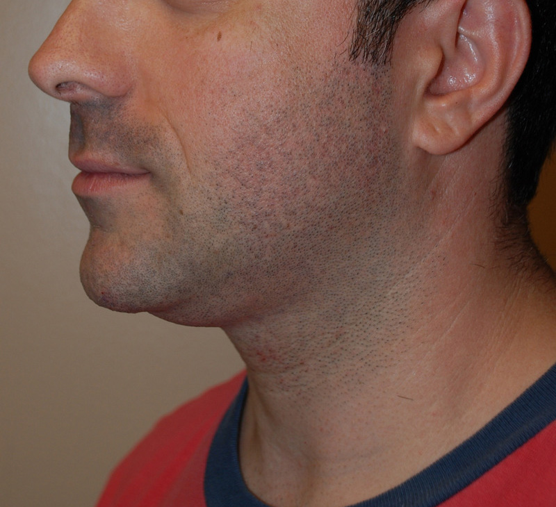Neck-Liposuction-04 | Before Neck Liposuction