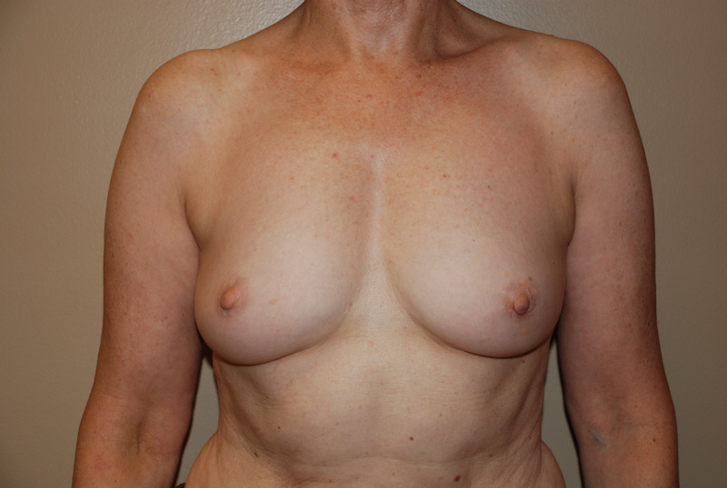 Breast-Reconstruction-Immediate-Implant-03 | Before Breast Reconstruction Immediate Implant
